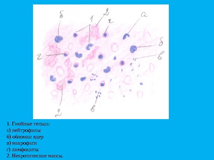 1. Гнойныетельца: а)нейтрофилы б)обломкиядер в)макрофаги г)лимфоциты 2. Некротическиемассы. 