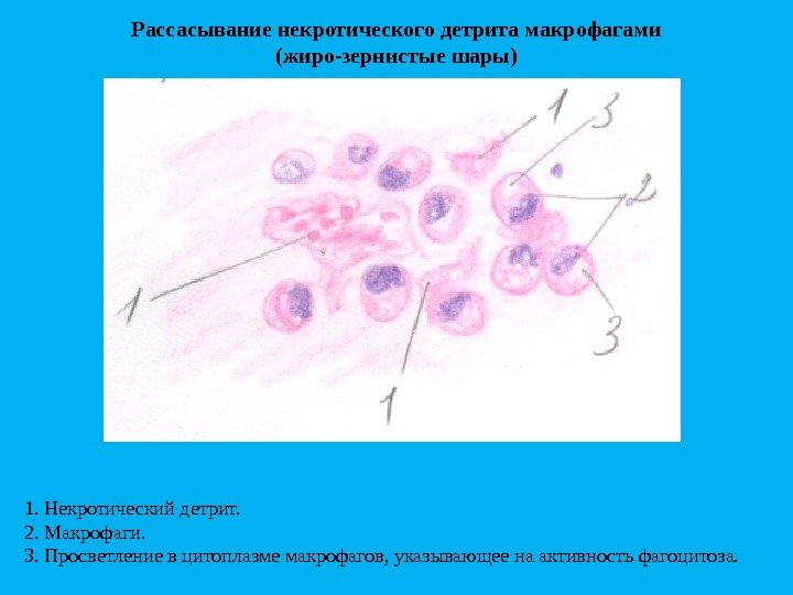 Рассасывание некротического детрита макрофагами (жиро-зернистые шары) 1. Некротическийдетрит. 2. Макрофаги. 3. Просветлениевцитоплазмемакрофагов, указывающеенаактивностьфагоцитоза. 