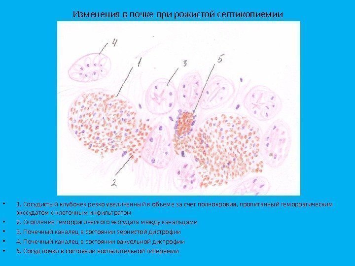 Изменения в почке при рожистой септикопиемии • 1. Сосудистый клубочек резко увеличенный в объеме