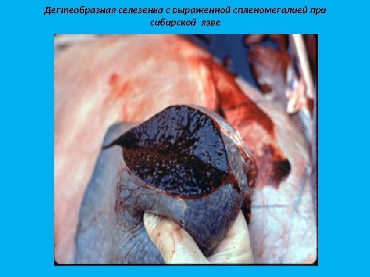 Дегтеобразная селезенка с выраженной спленомегалией при сибирской язве 
