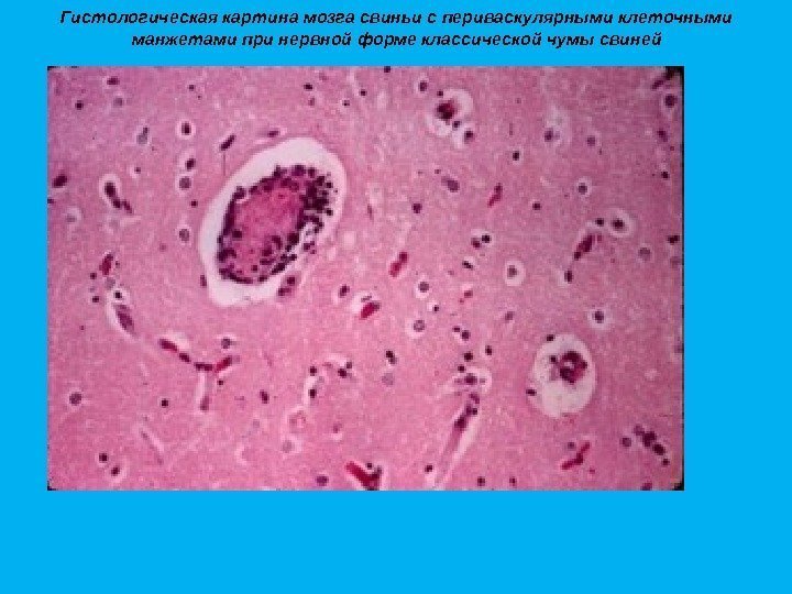 Гистологическая картина мозга свиньи с периваскулярными клеточными манжетами при нервной форме классической чумы свиней