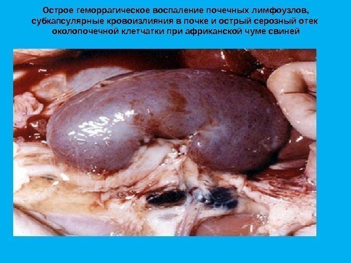 Острое геморрагическое воспаление почечных лимфоузлов,  субкапсулярные кровоизлияния в почке и острый серозный отек