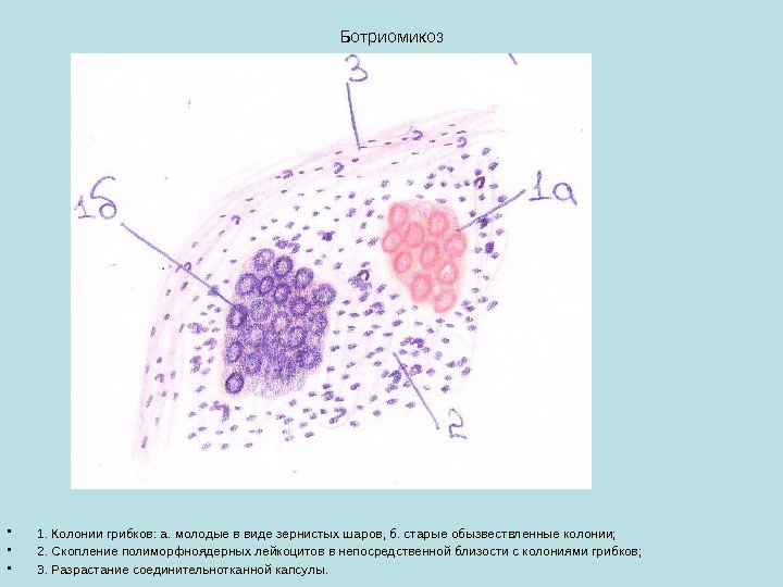 Ботриомикоз • 1. Колонии грибков: а. молодые в виде зернистых шаров, б. старые обызвествленные