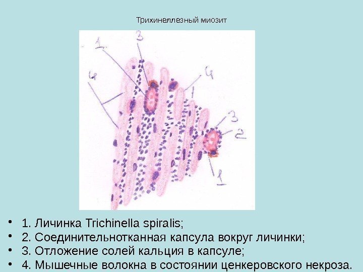 Трихинеллезный миозит • 1. Личинка Trichinella spiralis;  • 2. Соединительнотканная капсула вокруг личинки;
