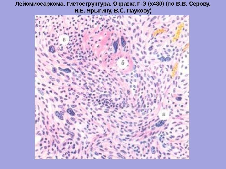 Лейомиосаркома. Гистоструктура. Окраска Г-Э (х480) (по В. В. Серову,  Н. Е. Ярыгину, В.