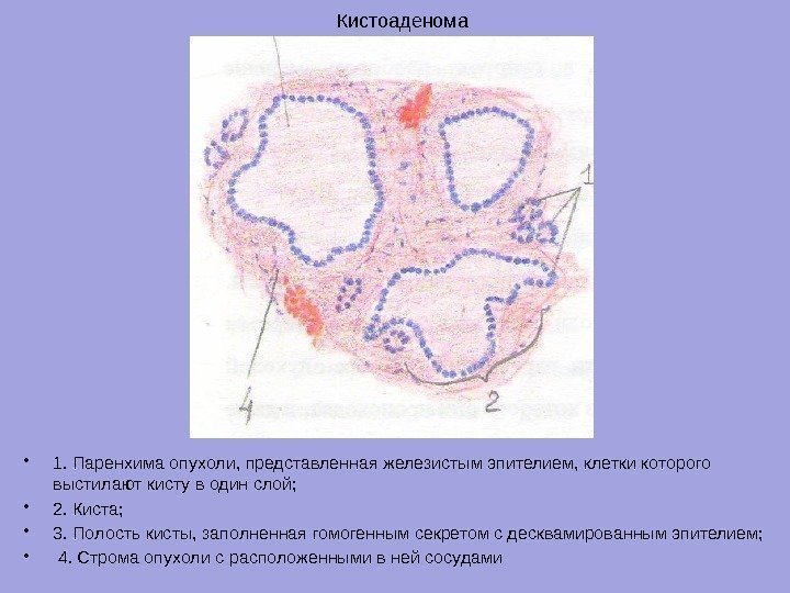 Кистоаденома • 1. Паренхима опухоли, представленная железистым эпителием, клетки которого выстилают кисту в один