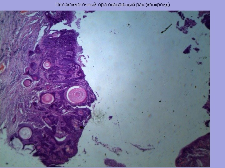 Плоскоклеточный ороговевающий рак (канкроид) 