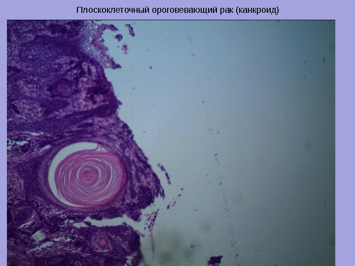 Плоскоклеточный ороговевающий рак (канкроид) 