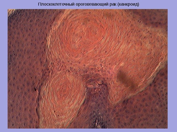 Плоскоклеточный ороговевающий рак (канкроид) 