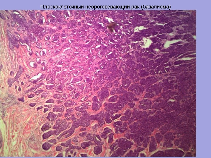 Плоскоклеточный неороговевающий рак (базалиома) 