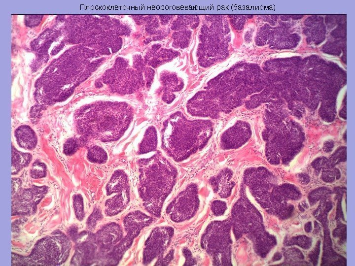 Плоскоклеточный неороговевающий рак (базалиома) 