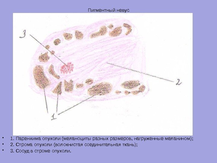 Пигментный невус • 1. Паренхима опухоли (меланоциты разных размеров, нагруженные меланином);  • 2.