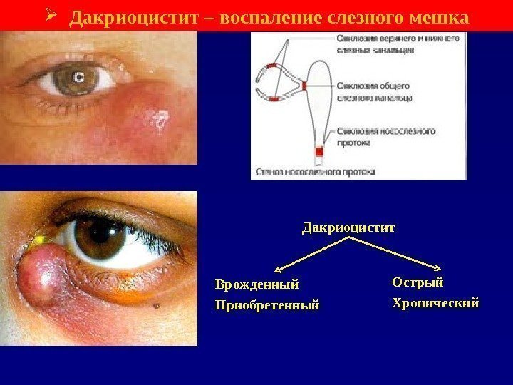  Дакриоцистит – воспаление слезного мешка Острый Хронический. Врожденный Приобретенный Дакриоцистит 
