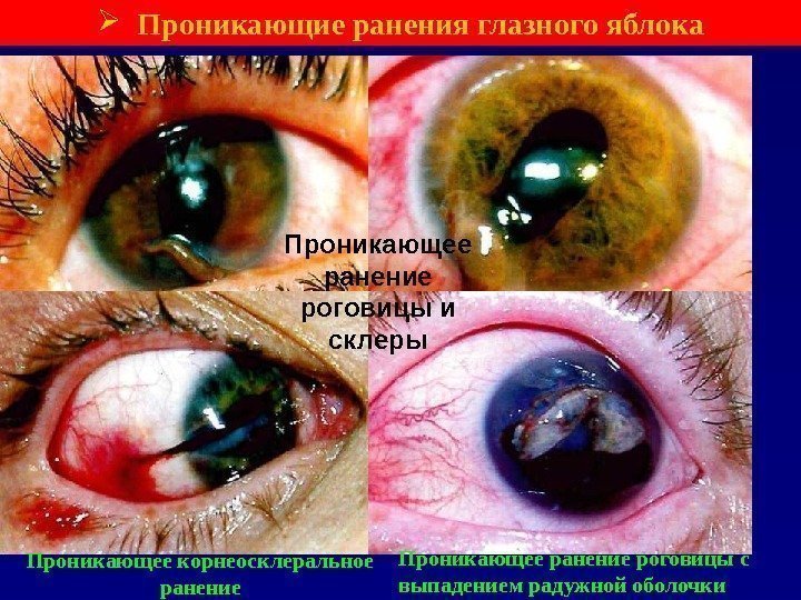  Проникающие ранения глазного яблока Проникающее ранение роговицы и склеры Проникающее корнеосклеральное ранение Проникающее