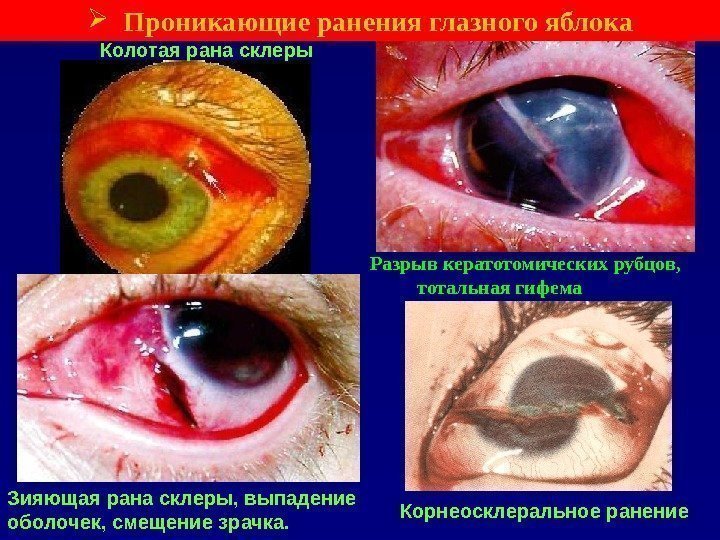  Проникающие ранения глазного яблока Колотая рана склеры Зияющая рана склеры, выпадение оболочек, смещение