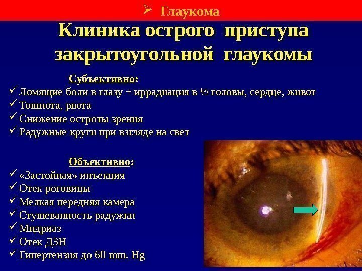 Клиника острого приступа закрытоугольной глаукомы Субъективно :  Ломящие боли в глазу + иррадиация