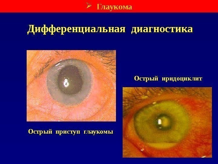 Дифференциальная диагностика Острый приступ глаукомы Острый иридоциклит Глаукома 