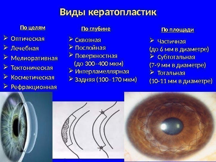 Кератопластика. Передняя послойная кератопластика роговицы. Сквозная кератопластика ход операции. Васкуляризированное бельмо роговицы офтальмология. Лечебная послойная кератопластика.