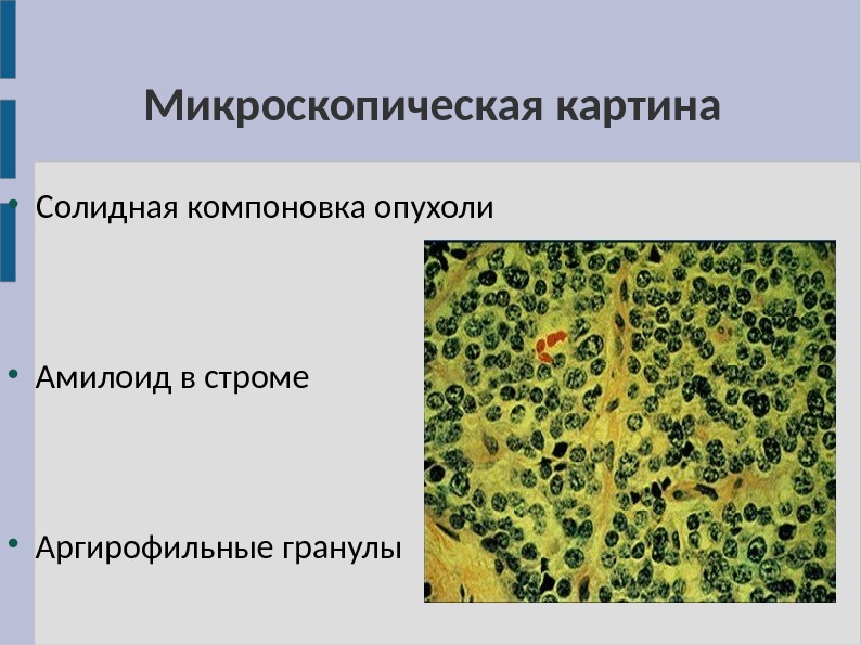 Микроскопическая картина Солидная компоновка опухоли Амилоид в строме Аргирофильные гранулы 