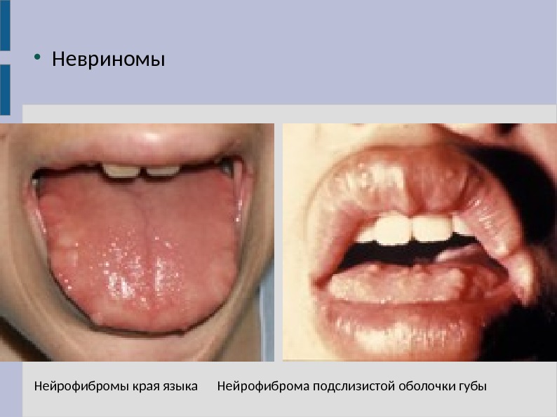  Невриномы Нейрофибромы края языка Нейрофиброма подслизистой оболочки губы 