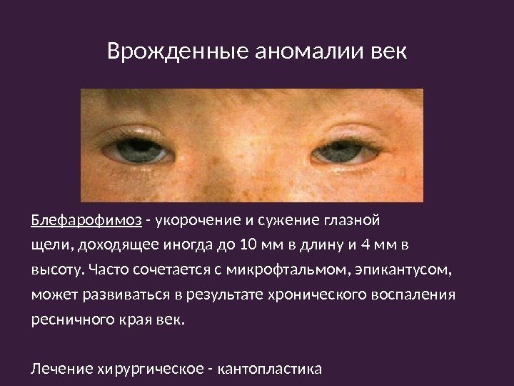 Врожденные аномалии век Блефарофимоз - укорочение и сужение глазной щели, доходящее иногда до 10