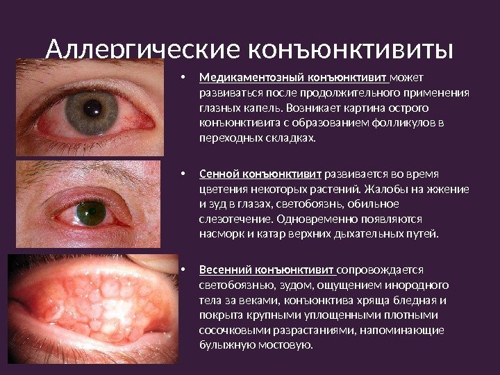  • Медикаментозный конъюнктивит может развиваться после продолжительного применения глазных капель. Возникает картина острого