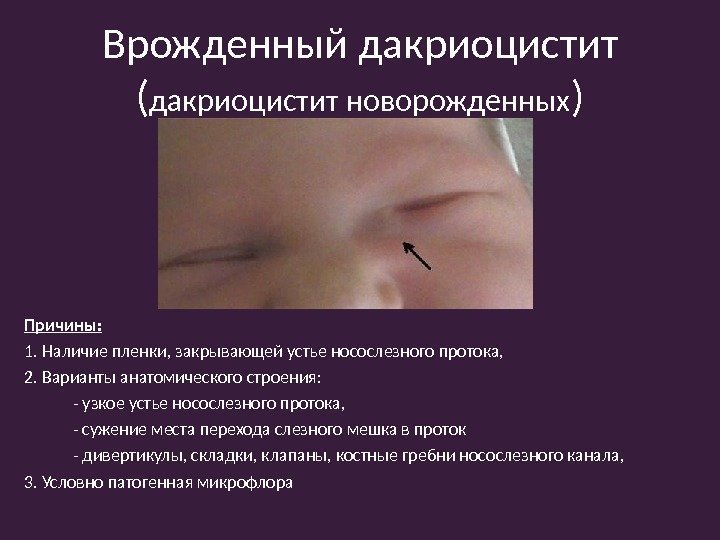 Врожденный дакриоцистит ( дакриоцистит новорожденных ) Причины: 1. Наличие пленки, закрывающей устье носослезного протока,