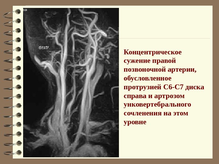   Концентрическое сужение правой позвоночной артерии,  обусловленное протрузией С 6 -С 7