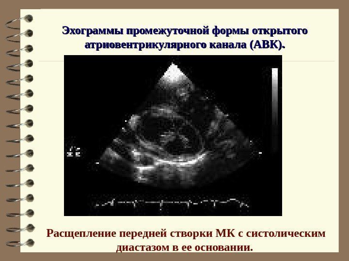   Эхограммы промежуточной формы открытого атриовентрикулярного канала (АВК). Расщепление передней створки МК с