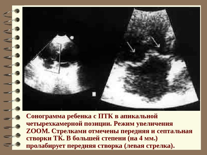   Сонограмма ребенка с ПТК в апикальной четырехкамерной позиции. Режим увеличения ZOOM. Стрелками