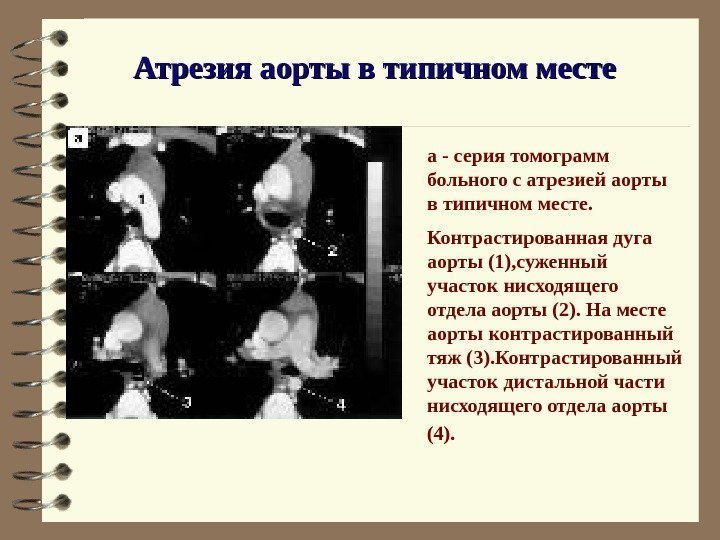   Атрезия аорты в типичном месте а - серия томограмм больного с атрезией