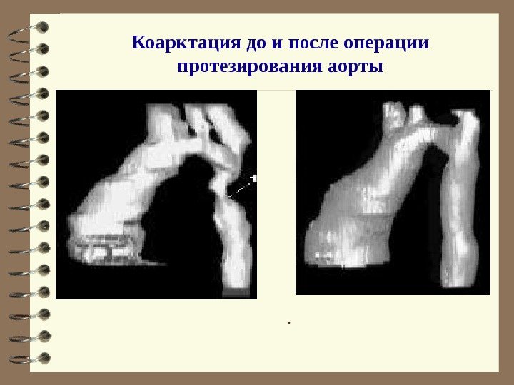   Коарктация до и после операции протезирования аорты. 