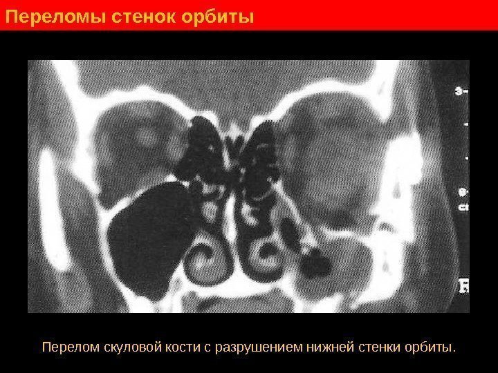   Переломы стенок орбиты Перелом скуловой кости с разрушением нижней стенки орбиты. 