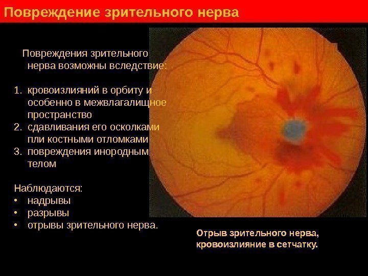   Повреждение зрительного нерва Повреждения зрительного нерва возможны вследствие:  1. кровоизлияний в
