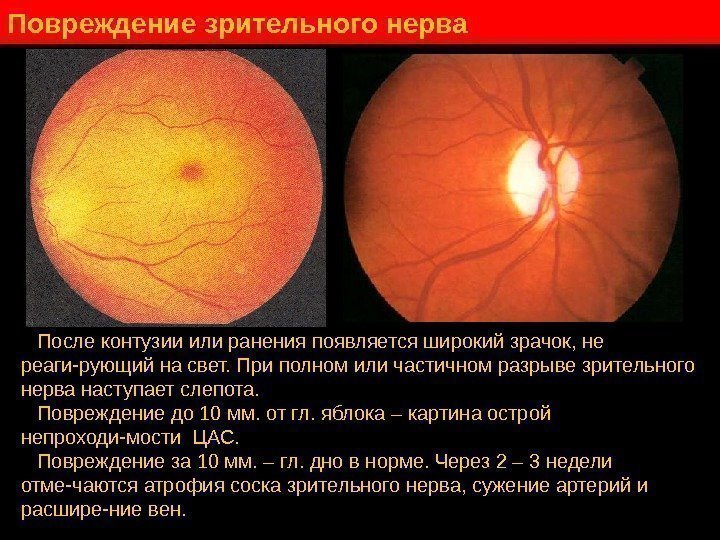   Повреждение зрительного нерва После контузии или ранения появляется широкий зрачок, не реаги-рующий