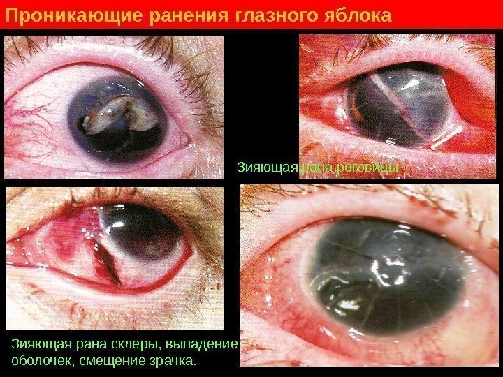   Проникающие ранения глазного яблока Зияющая рана склеры, выпадение оболочек, смещение зрачка. Зияющая