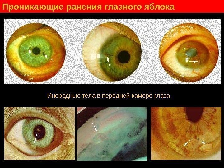   Проникающие ранения глазного яблока Инородные тела в передней камере глаза 