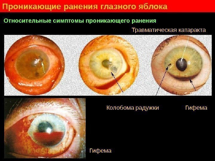   Проникающие ранения глазного яблока Относительные симптомы проникающего ранения Колобома радужки  
