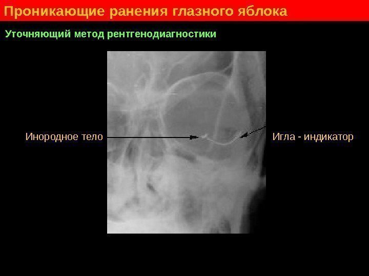   Проникающие ранения глазного яблока Уточняющий метод рентгенодиагностики Инородное тело Игла - индикатор