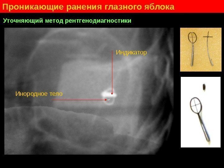   Проникающие ранения глазного яблока Уточняющий метод рентгенодиагностики Инородное тело Индикатор 
