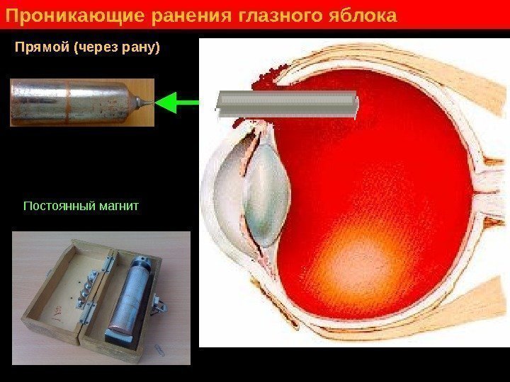   Проникающие ранения глазного яблока Прямой (через рану) Инородное тело Постоянный магнит 