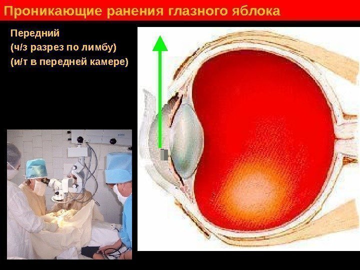   Проникающие ранения глазного яблока Передний (ч / з разрез по лимбу) (и