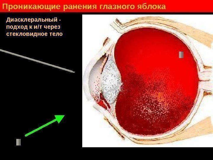   Проникающие ранения глазного яблока Диасклеральный - подход к и / т через