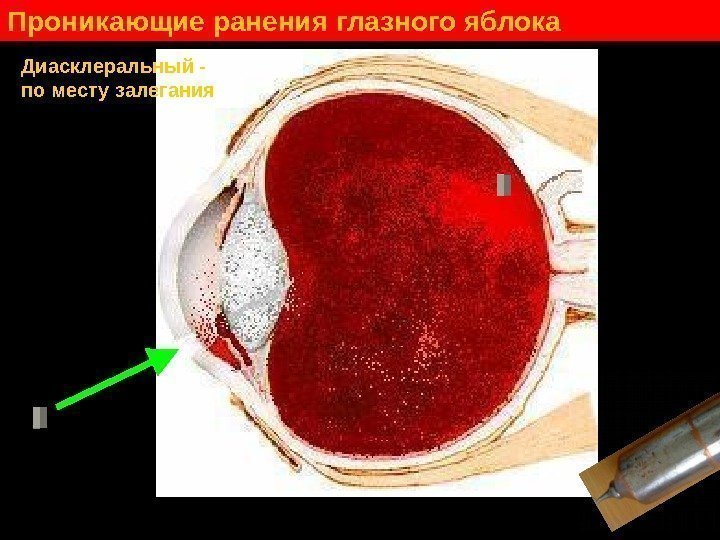   Проникающие ранения глазного яблока Диасклеральный - по месту залегания 