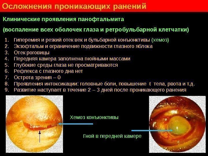   Клинические проявления панофтальмита (воспаление всех оболочек глаза и ретробульбарной клетчатки) 1. 