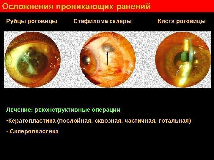   Осложнения проникающих ранений Рубцы роговицы   Стафилома склеры   