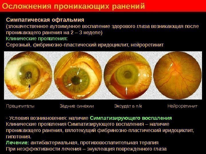   Симпатическая офтальмия (злокачественное аутоимунное воспаление здорового глаза возникающая после проникающего ранения на