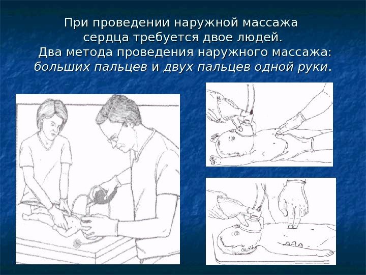 При проведении наружной массажа сердца требуется двое людей.  Два метода проведения наружного массажа: