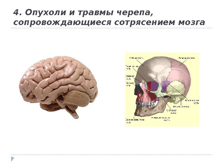 4. Опухоли и травмы черепа,  сопровождающиеся сотрясением мозга 