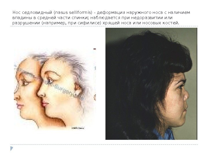 Нос седловидный (nasus selliformis) - деформация наружного носа с наличием впадины в средней части